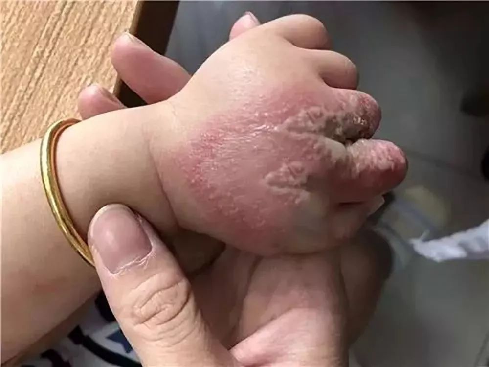 隱翅蟲的毒性有（yǒu）多強？體液比眼鏡蛇更毒，捕蠅草吸收它都會枯萎（wěi）