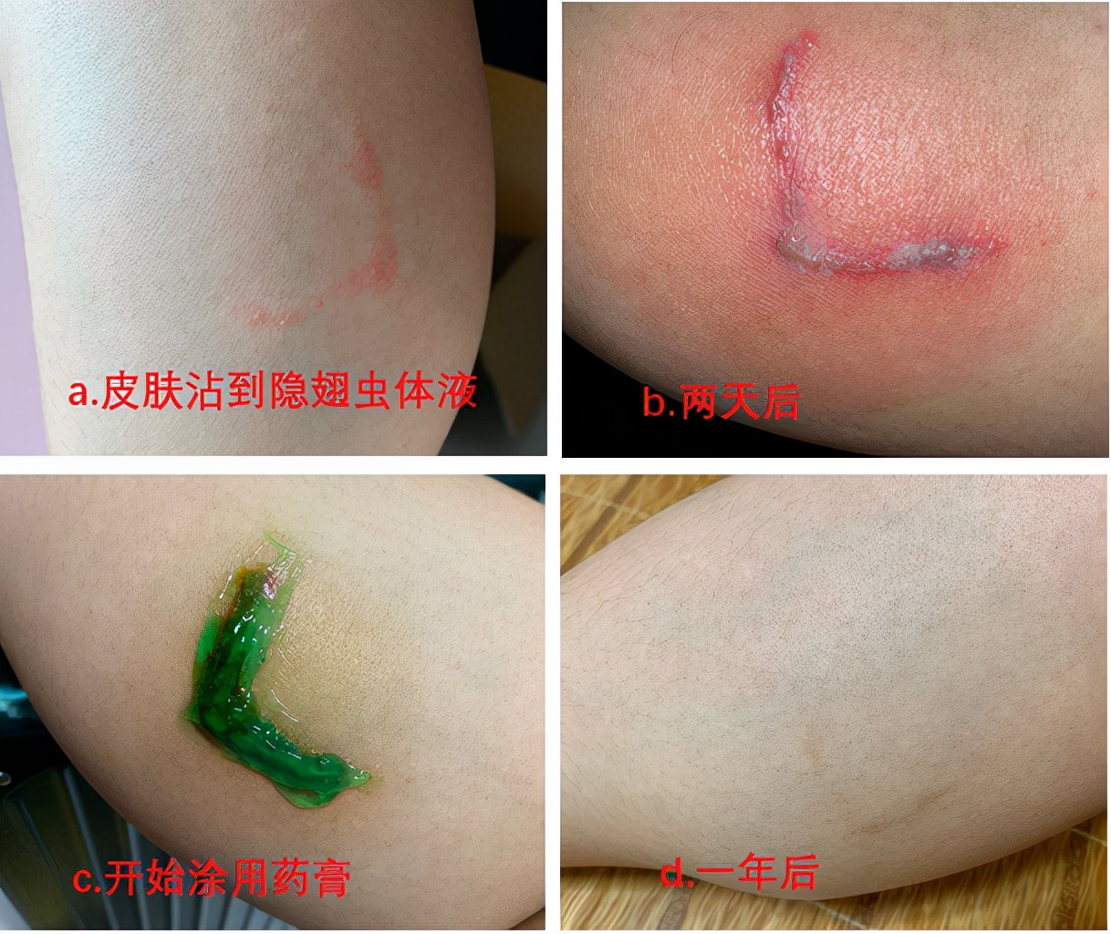 隱翅蟲的毒性有多強？體液（yè）比眼鏡蛇更毒，捕蠅草吸收它都會枯萎